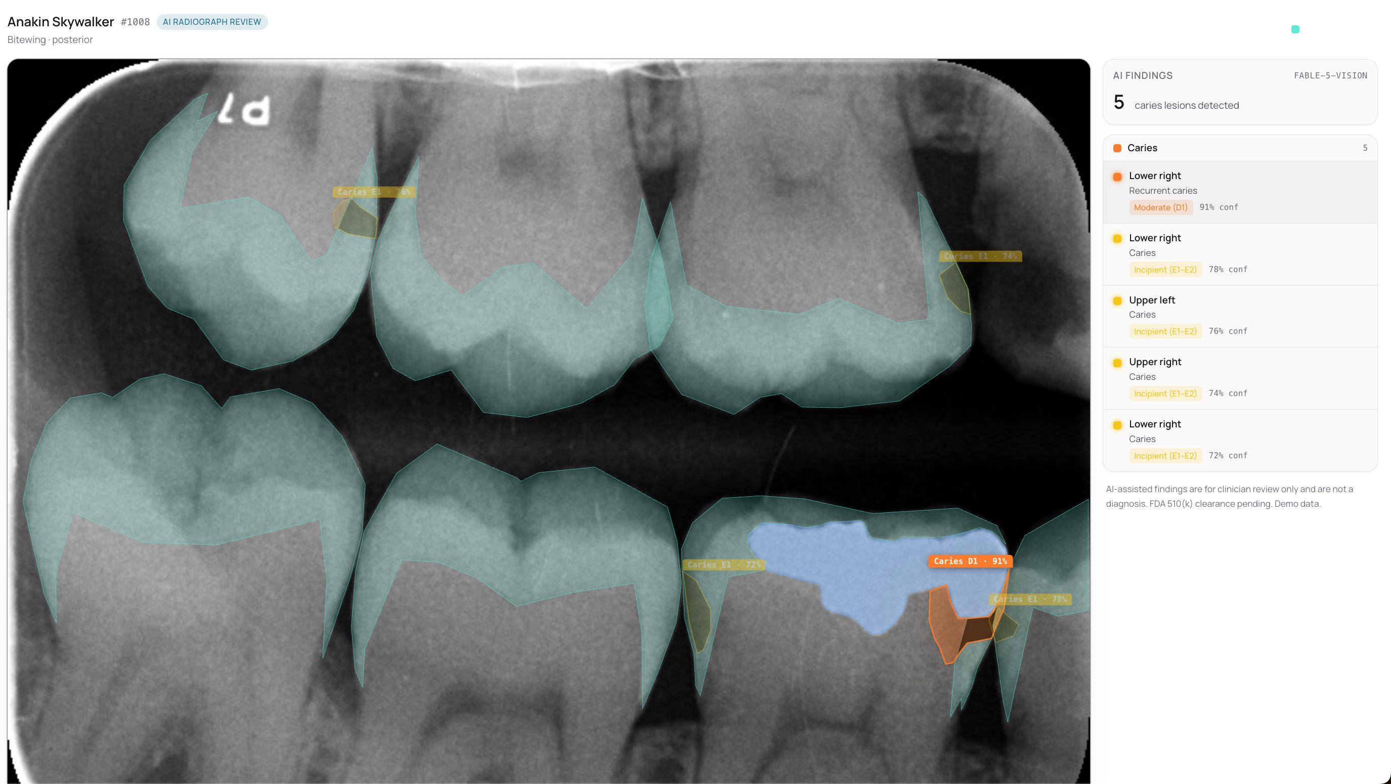 Skia AI reading a bitewing radiograph — caries detection with confidence scores